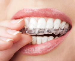 Tandskena fylls med blekgel och sätts ovanpå tänderna